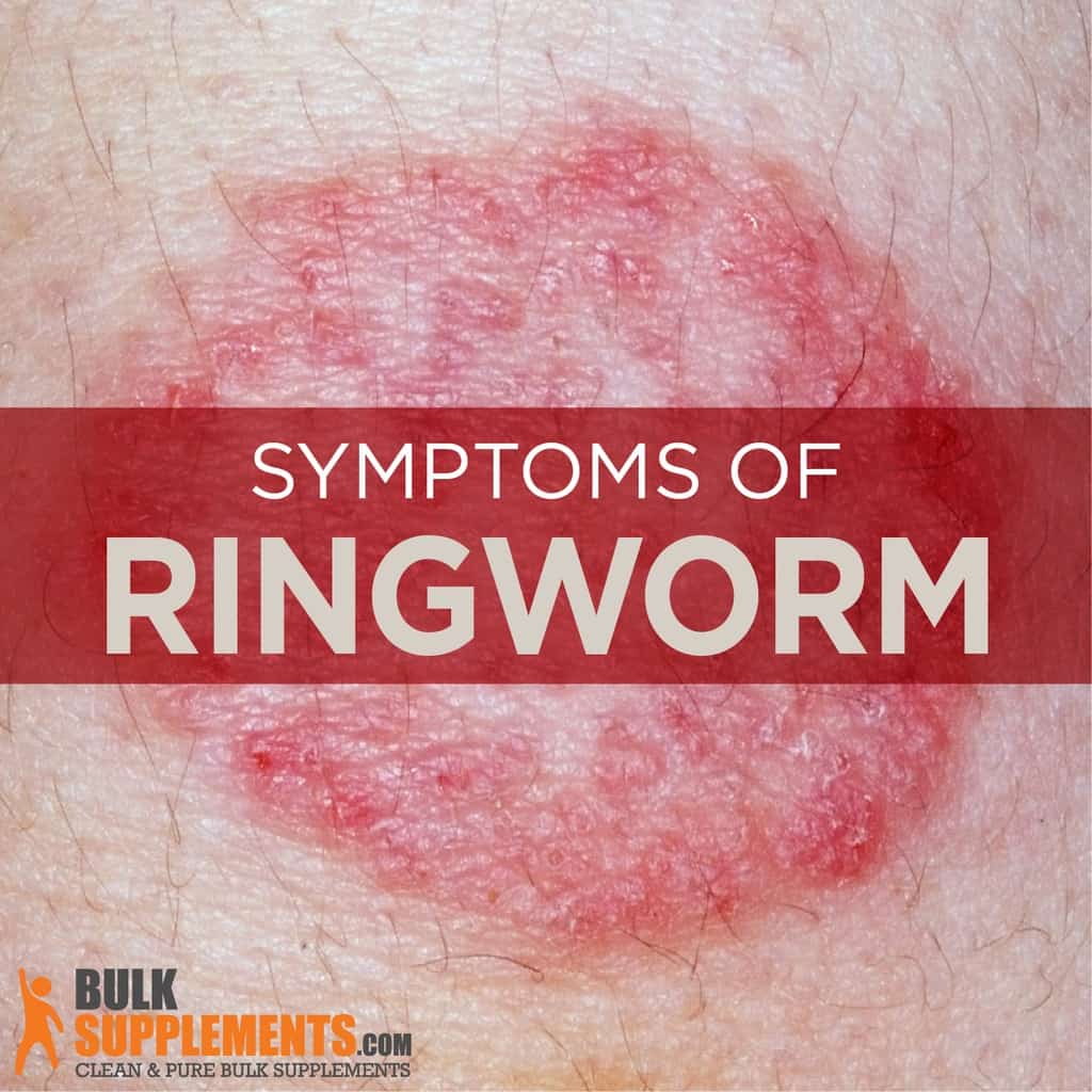 Ringworm rid ringworms remedies common naturally worry considered nothing there most these