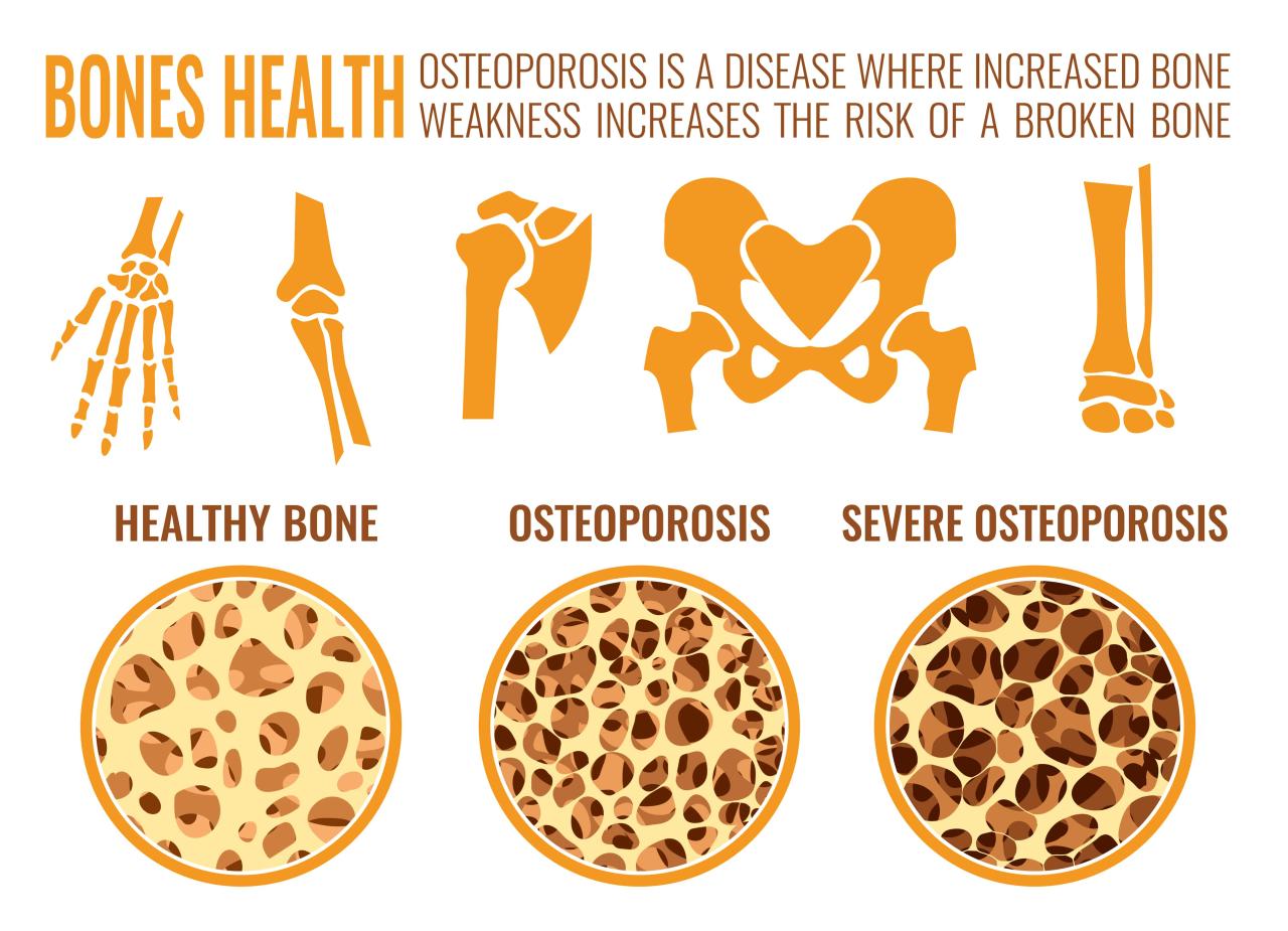 Bagaimana cara mengurangi risiko osteoporosis