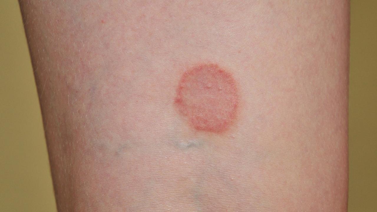 Ringworm treat remedies ringworms worm tinea stylecraze