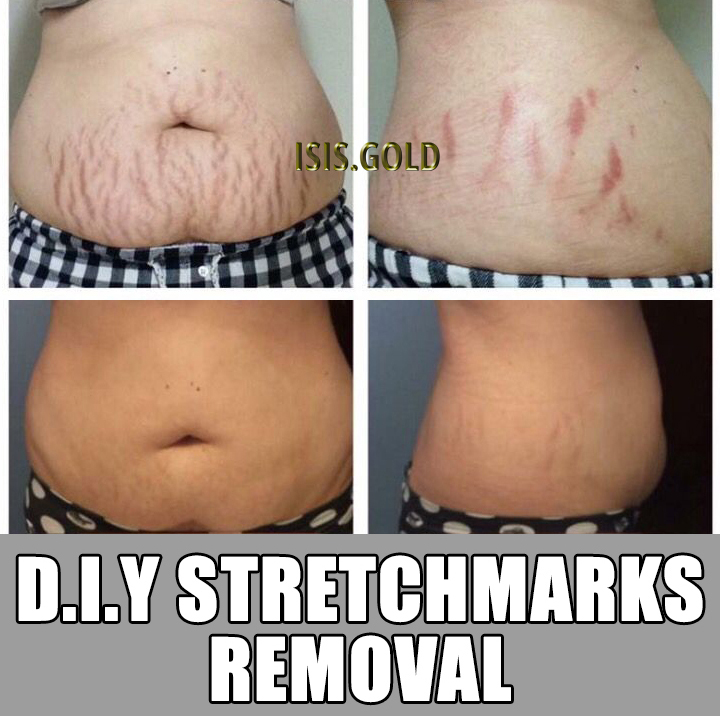 Begini cara menghilangkan stretch mark yang efektif