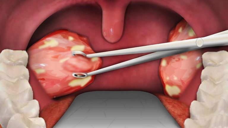 Tonsillectomy cost indications recovery post time