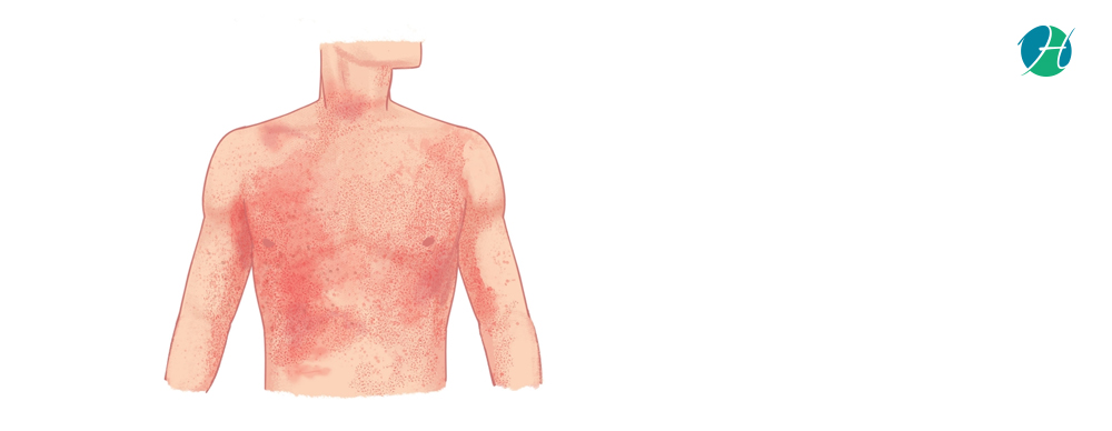 Typhoid causes