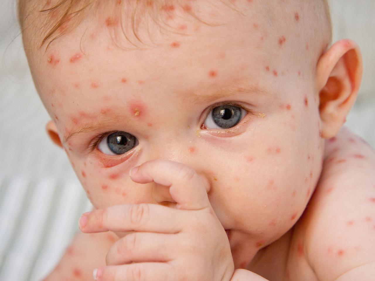 Chickenpox causes remedies important facts healthy living