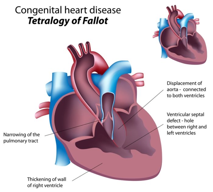 Heart congenital defect chd nursing disease vsd septal ventricular pediatric surgery fiddaman pediatrics patient education respiratory health born choose board