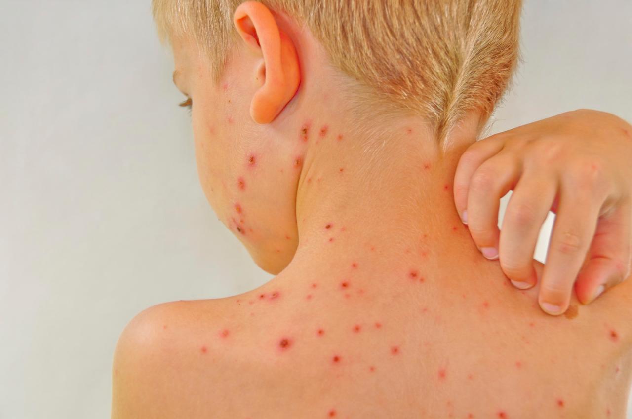 Chickenpox measles basic information vaccine old