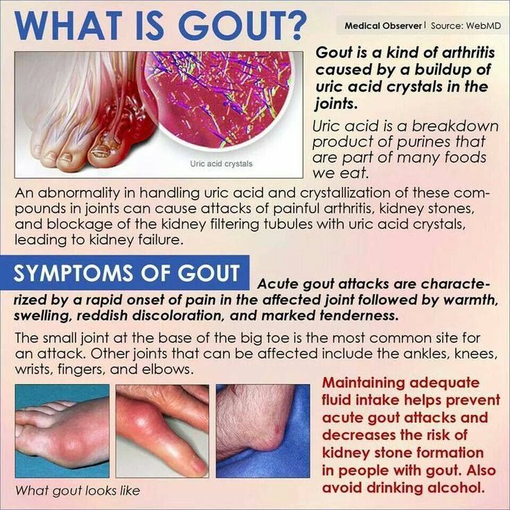 Gout disease treatment prevent need know symptom pain major being