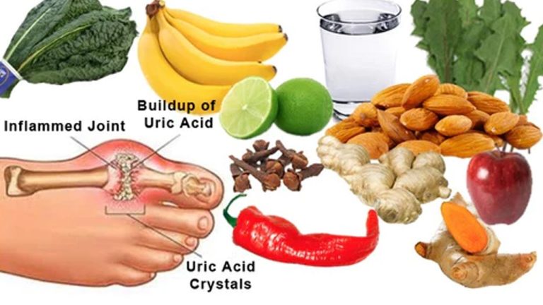 Uric acid foods levels cure