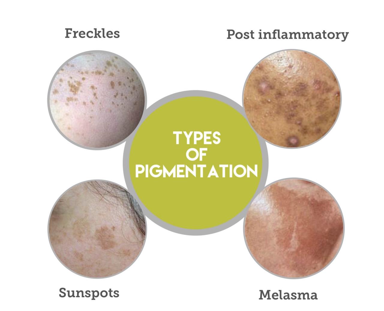 Pigmentation discoloration genetics olah verywell treatment