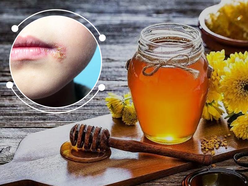 Mengenali gejala dan obat herpes alami