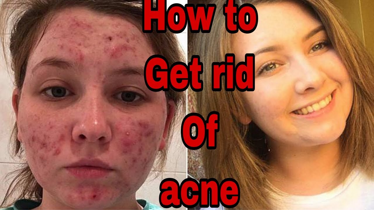 Acne after inflamed before non hyperpigmentation