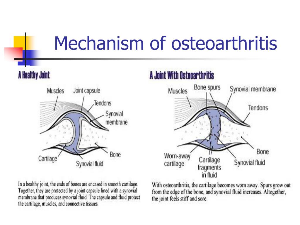 Peran glucosamine dalam mengatasi gejala osteoarthritis