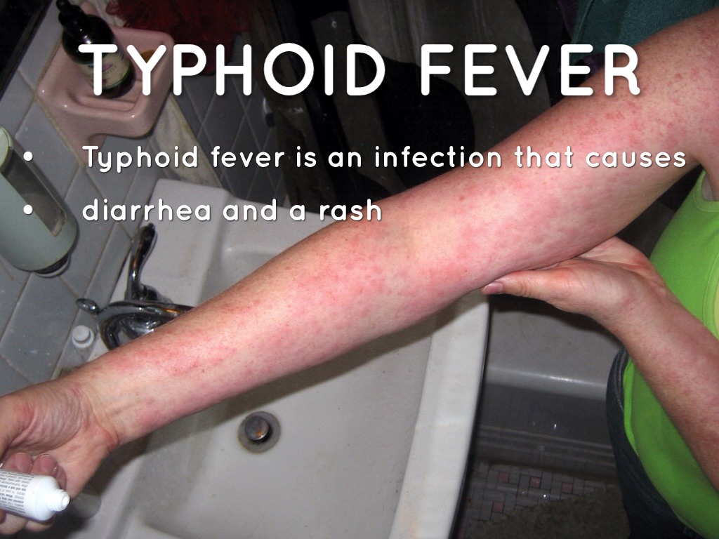 Typhoid healthsoul causes