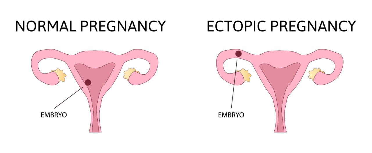 Ectopic pregnancy sites its diagnosis labpedia abdominal ovary cervix