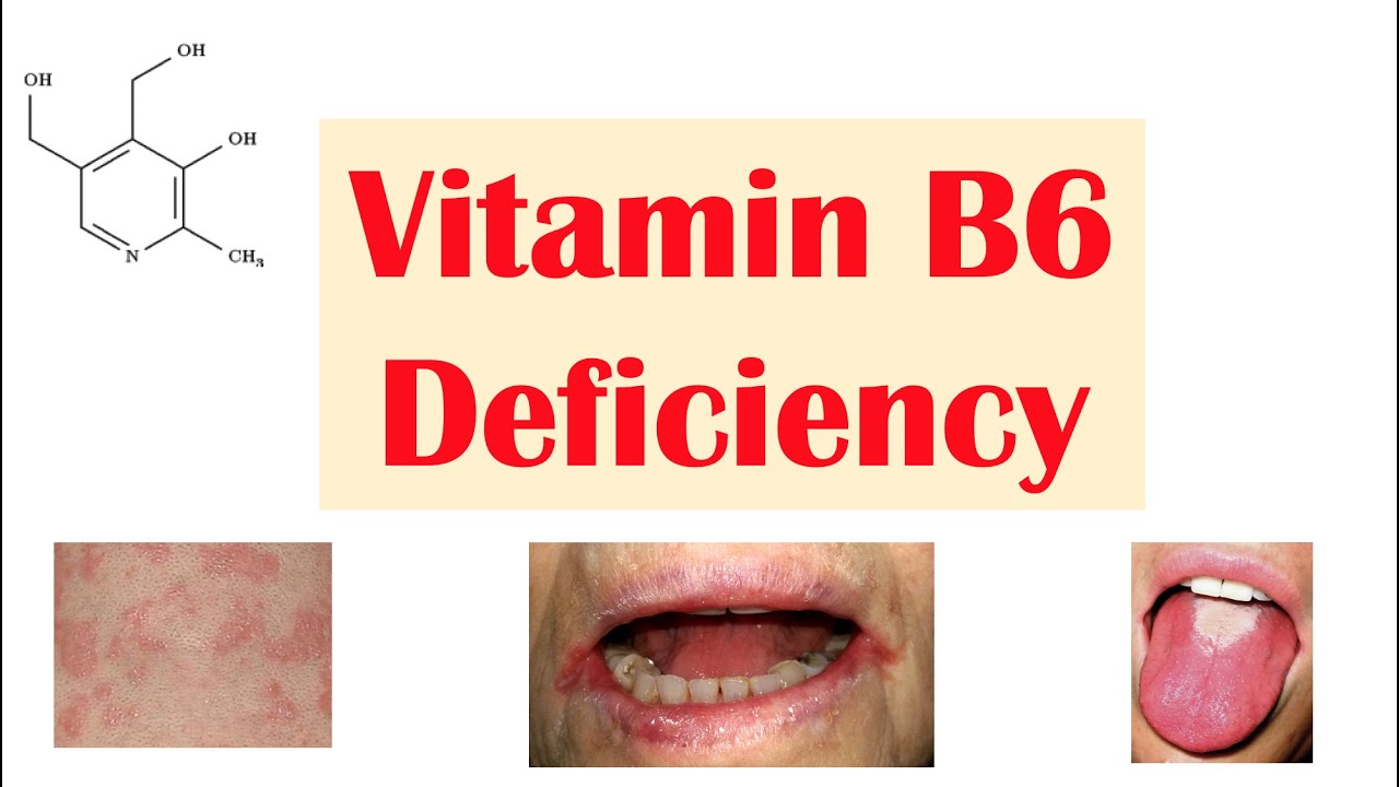 B6 vitamin deficiency signs health