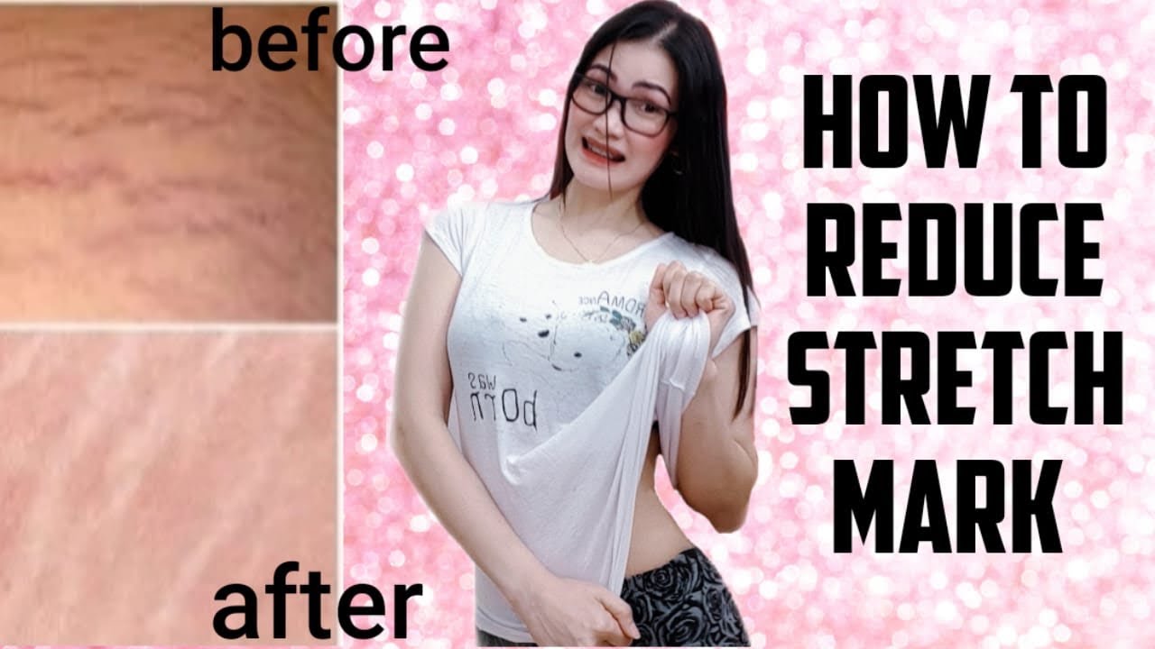 Bagian tubuh rentan stretch mark dan cara menghilangkannya